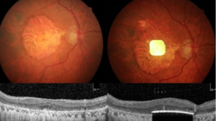 Томруулж харах Харааг хэсэгчлэн сэргээх шинэ технологи зохион бүтээлээ